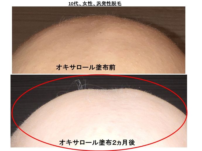 円形脱毛症　病院